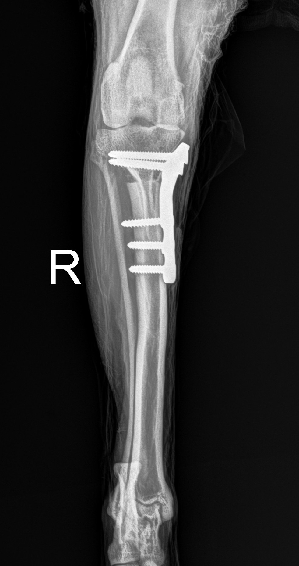 fracture repair